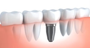 Dental Implants India